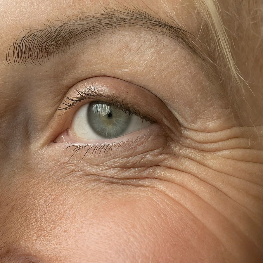 Fine lines and crow's feet